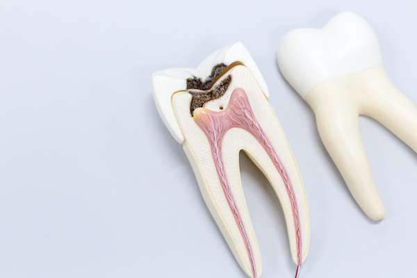Ask a General Dentist: Is a Tooth Dead After a Root Canal from Cedar Lane Family Dentistry in Franklin, IN