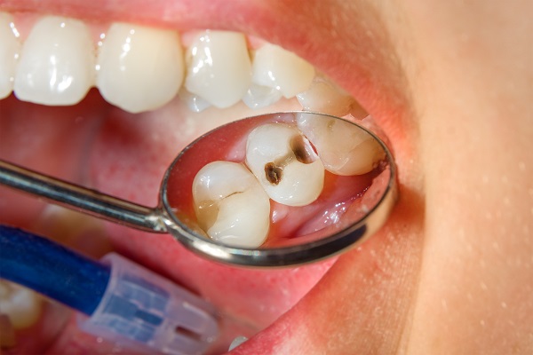 How Dental Fillings Can Repair Cavities