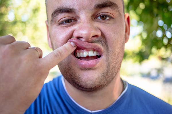 What Can Happen To An Untreated Chipped Tooth