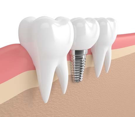 Dental Implant Franklin, IN