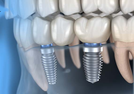 Dental Implant Franklin, IN