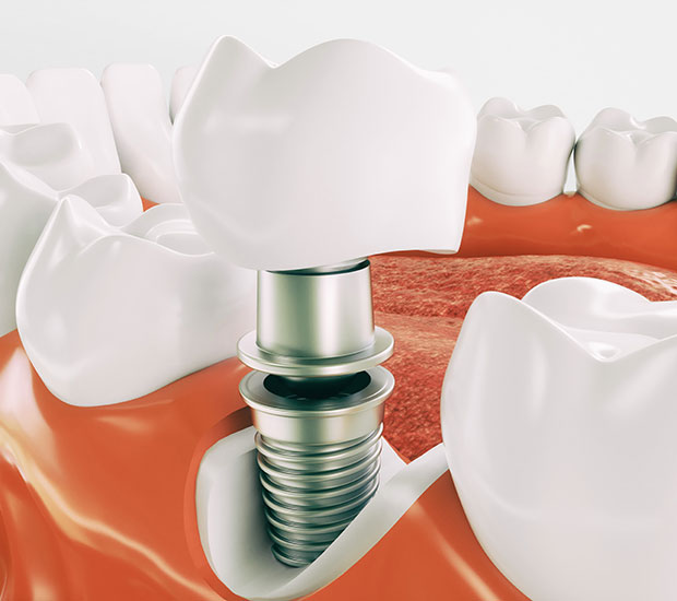 Franklin Dental Implant Restoration
