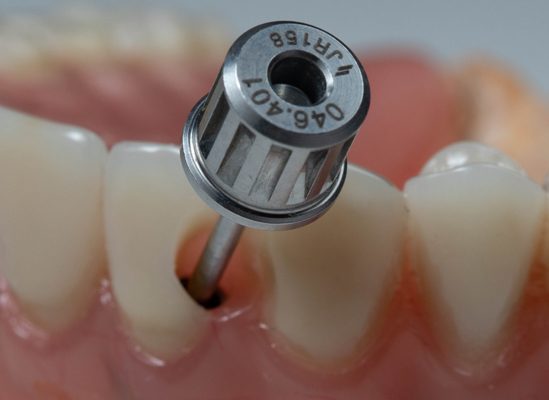 Proper Dental Implant Care In Your Oral Hygiene Routine