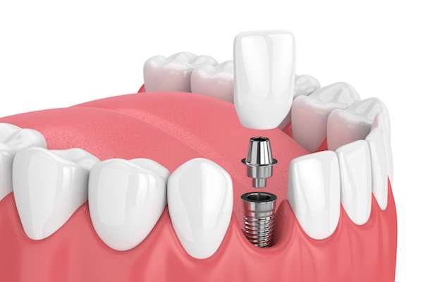 How Painful is Dental Implant Surgery from Cedar Lane Family Dentistry in Franklin, IN