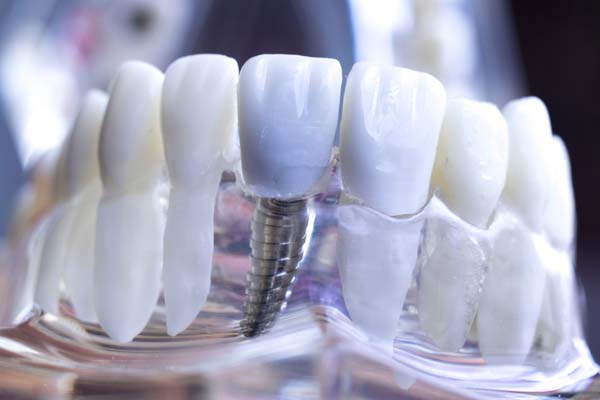 An Overview Of Implant Dentistry For Tooth Replacement
