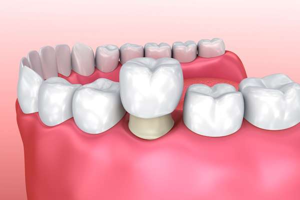 Permanent Dental Crowns vs. Temporary: Is There a Difference from Cedar Lane Family Dentistry in Franklin, IN