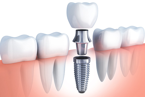 Questions to Ask Your Implant Dentist from Cedar Lane Family Dentistry in Franklin, IN