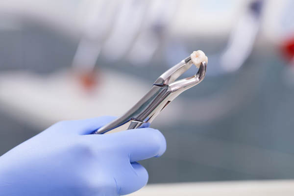 Reasons You Might Need A Tooth Extraction