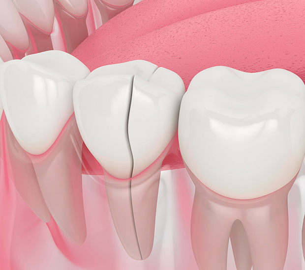 Franklin Types of Dental Root Fractures